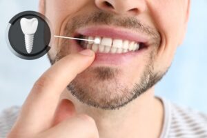 THE TRUTH BEHIND FULL-MOUTH DENTAL IMPLANTS REVEALED!