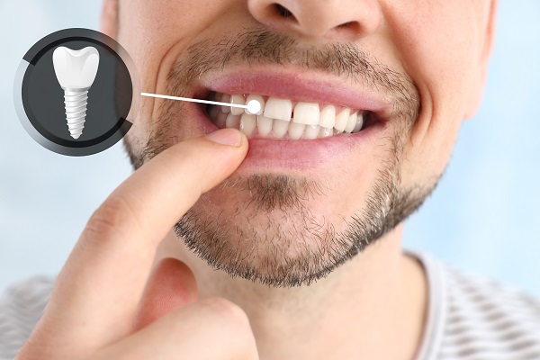  THE TRUTH BEHIND FULL-MOUTH DENTAL IMPLANTS REVEALED!