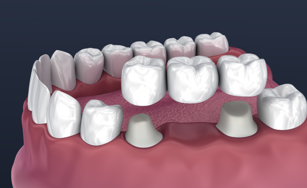 crown bridge teeth in navi mumbai