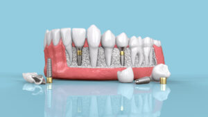 FUNCTIONAL ASPECT OF DENTAL IMPLANTS