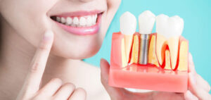 How long do dental implants last?