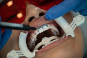 Full Mouth Reconstruction: Beyond Cosmetic Enhancement