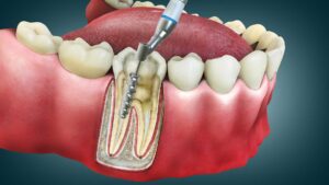 A Journey Through Root Canal Therapy: A Comprehensive Guide