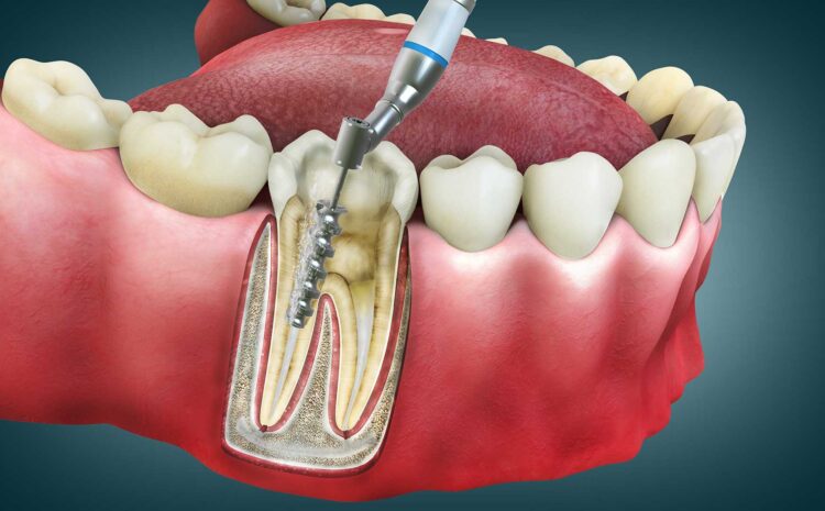  A Journey Through Root Canal Therapy: A Comprehensive Guide