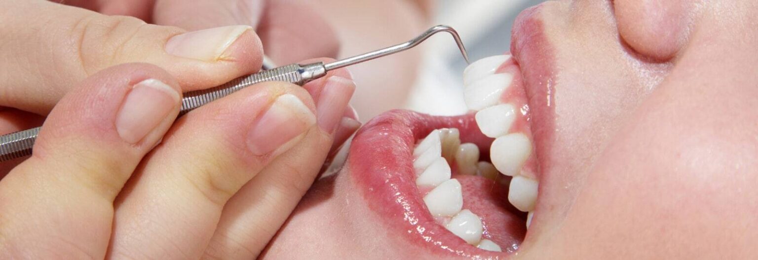 Teeth Cleaning and Polishing in Kharghar