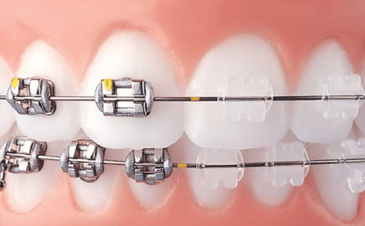  Caring for Your Braces: Expert Tips for a Beautiful Smile 