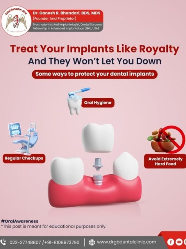 Give your dental implants the royal treatment!