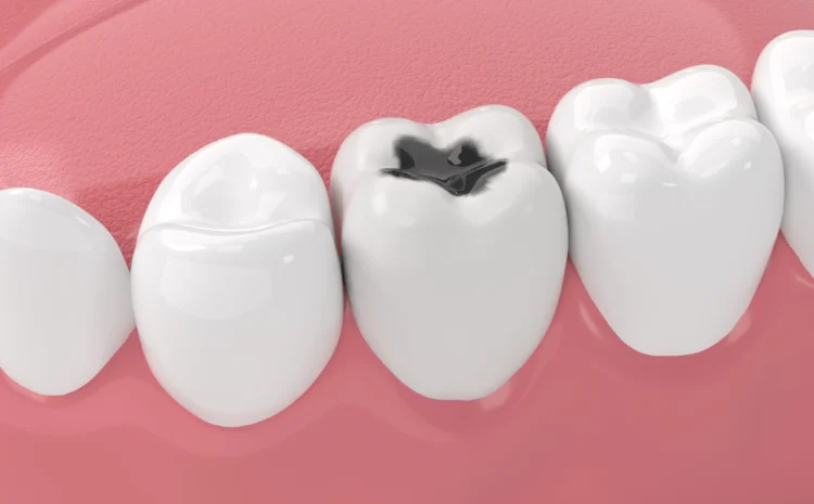 Cavity in Wisdom Tooth: Causes, Complications, and the Right Time for Removal