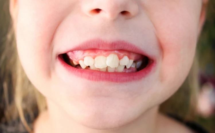  Crooked Teeth Treatment: Causes, Options, and Best Solutions 