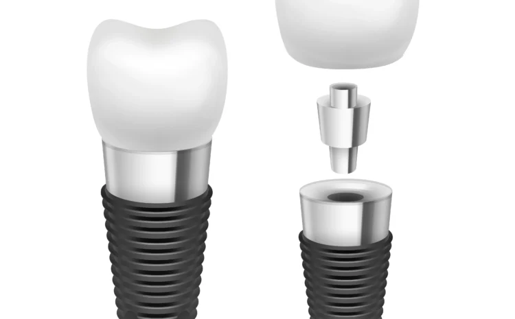  Dental Bridges vs Implants: Which Is Right for You? 