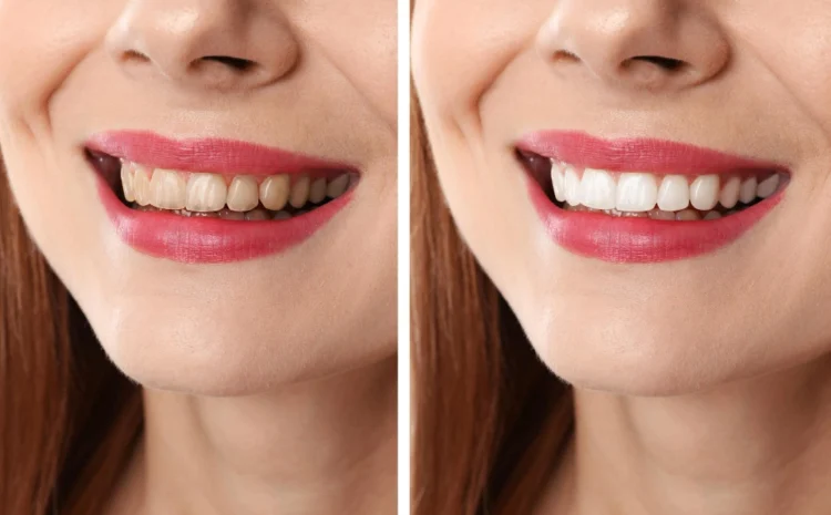 Dental Implants Before and After | Dr Ganesh Bhandari