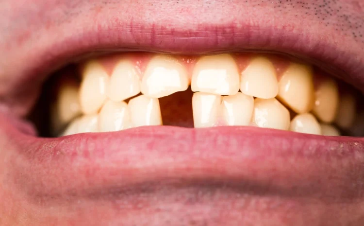  Broken or Chipped Tooth: Signs You Need a Dentist Right Away 