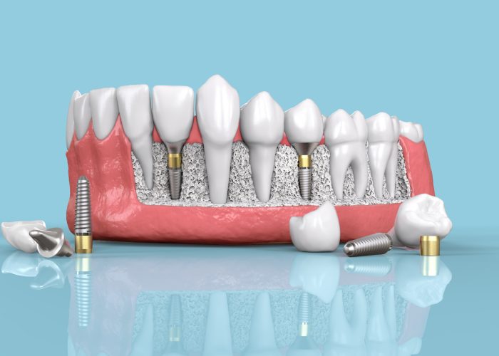 Functional Aspect Of Dental Implants