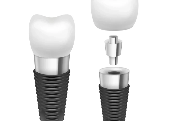Dental Bridges vs Implants: Which Is Right for You?