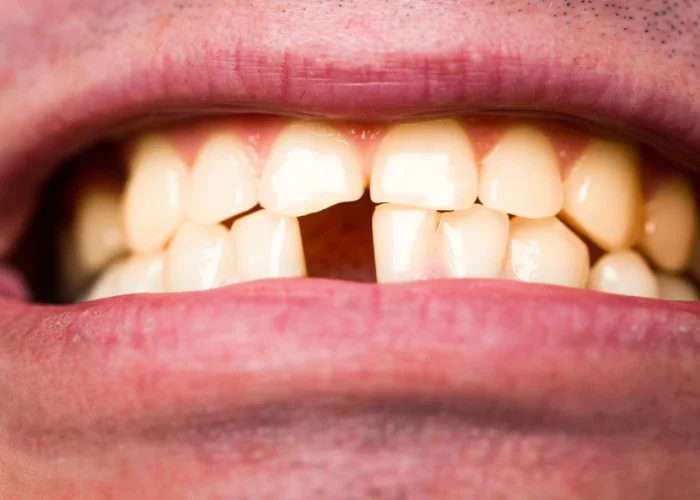 Broken or Chipped Tooth: Signs You Need a Dentist Right Away