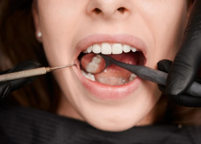 Common Mistakes That Damage Dental Crowns: Dr. Ganesh Bhandari