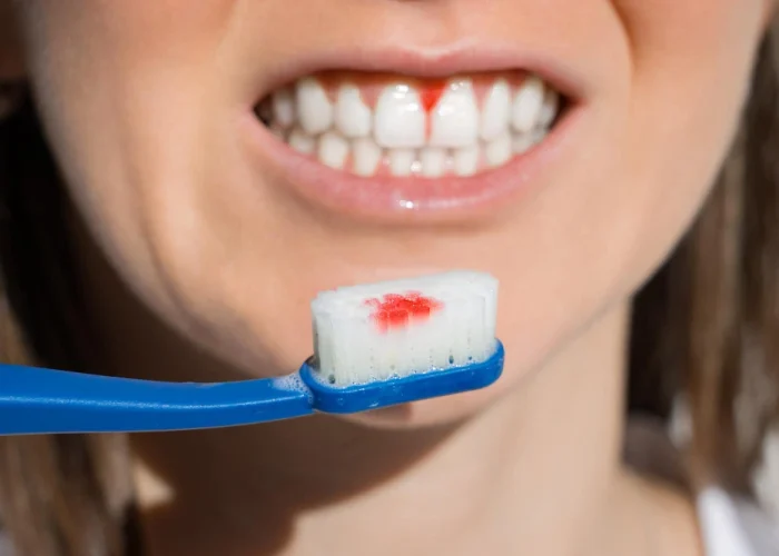 Are Bleeding Gums a Sign of Serious Dental Disease?