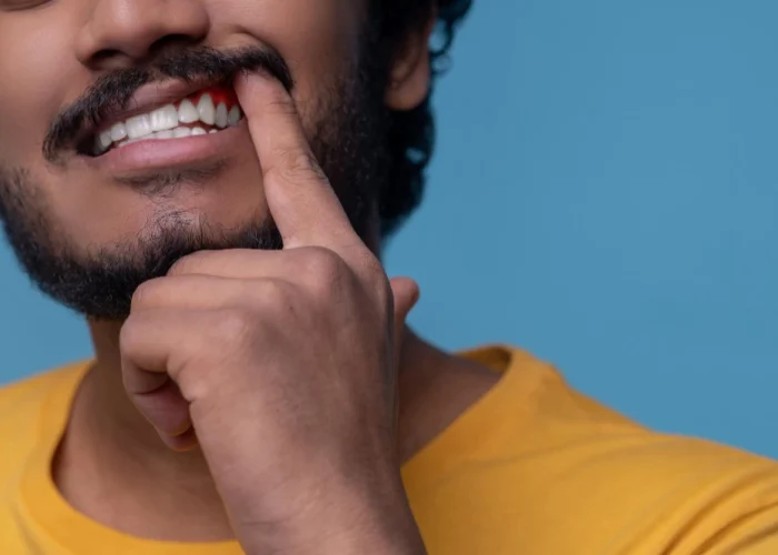 Are Bleeding Gums a Sign of Serious Dental Disease?