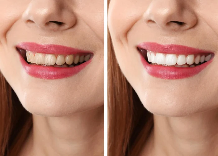 Dental Implants Before and After | Dr Ganesh Bhandari