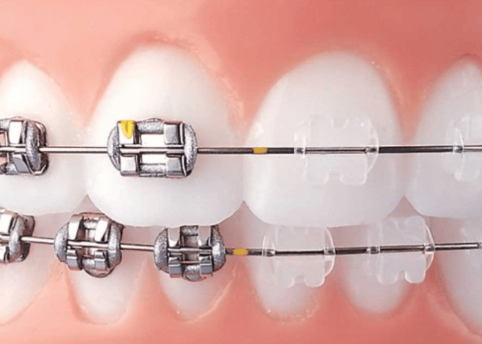 Caring for Your Braces: Expert Tips for a Beautiful Smile