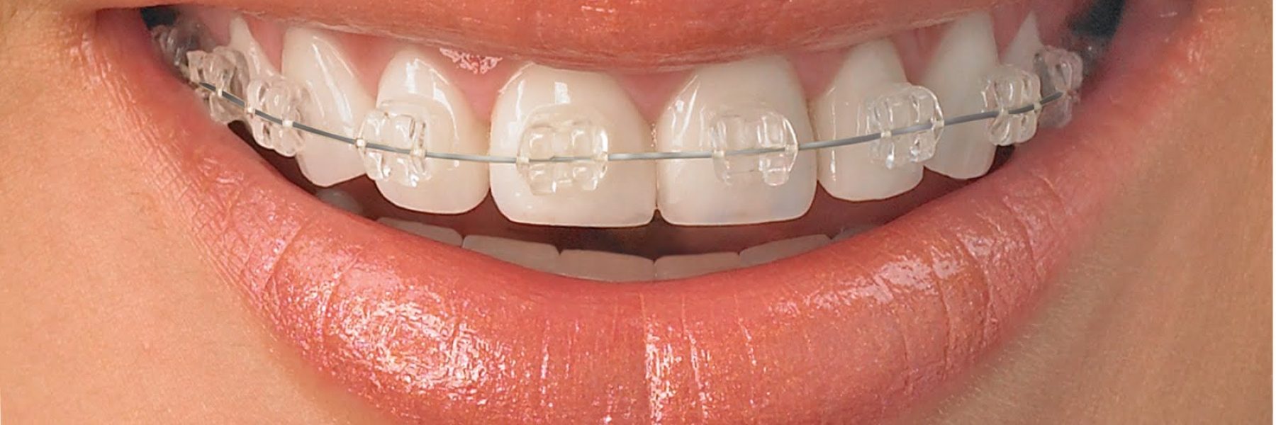 Ceramic Braces in Kharghar