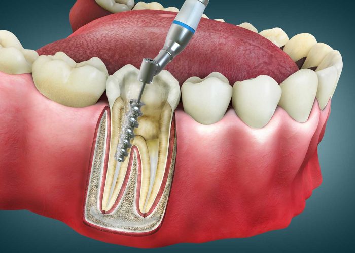 A Journey Through Root Canal Therapy: A Comprehensive Guide