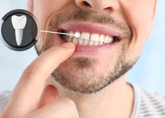 The Truth Behind Full-Mouth Dental Implants Revealed!