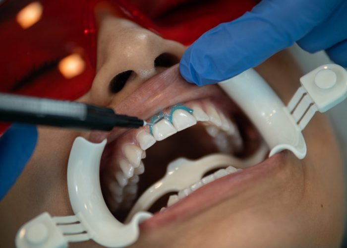 Closeup of young woman wearing mouth retractor waiting for oral examination in dentistry office.