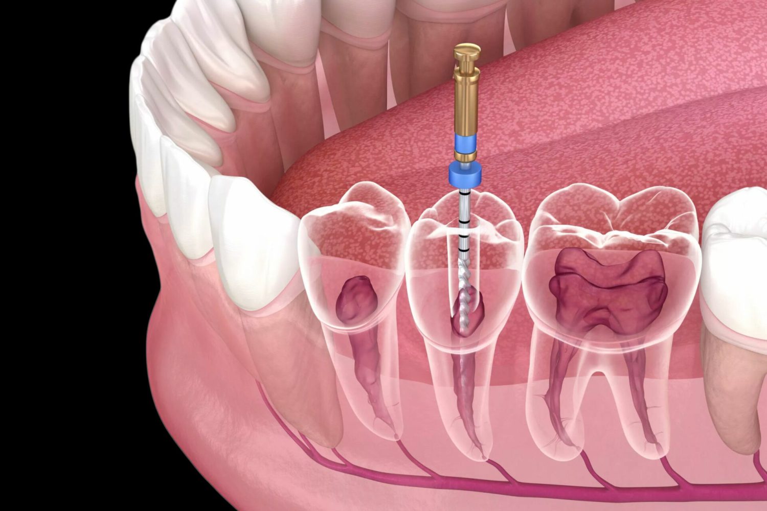 Root Canal Treatment in Kharghar, Navi MumbaiRoot Canal Treatment in Kharghar, Navi Mumbai