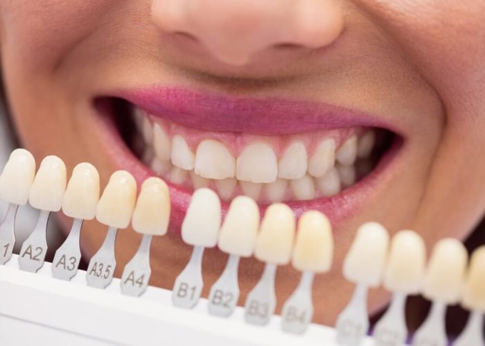Teeth Whitening Options: What’s Right for You?