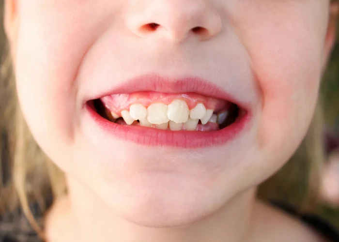 Crooked Teeth Treatment: Causes, Options, and Best Solutions