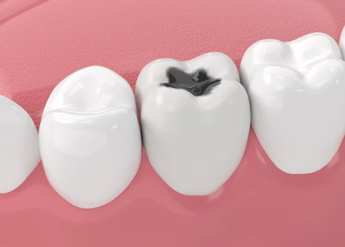 Cavity in Wisdom Tooth: Causes, Complications, and the Right Time for Removal