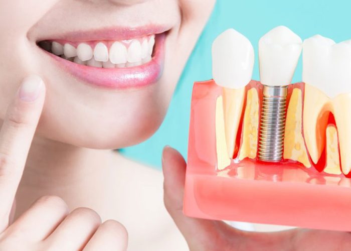 How long do dental implants last?